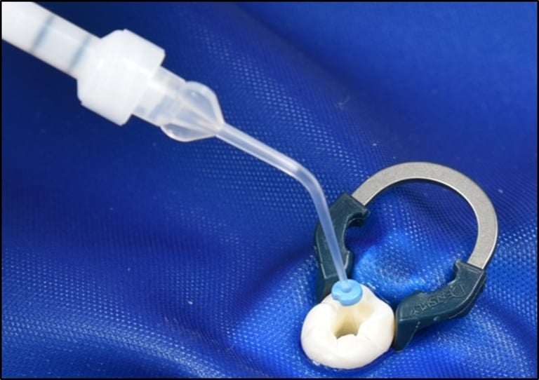 BisiSEAL MTA – Bioaktiver Wurzelkanal-Sealer für die Endodontie von Bisico Bielefelder Dentalsilicone GmbH & Co. KG – Bild 2