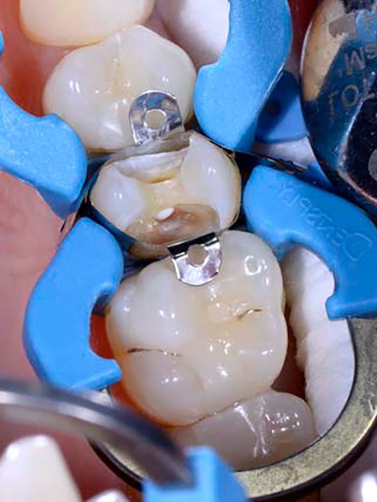 BisiCAL – Bioaktives Pulpaüberkappungsmaterial mit MTA-Füllstoffen von Bisico Bielefelder Dentalsilicone GmbH & Co. KG – Bild 2