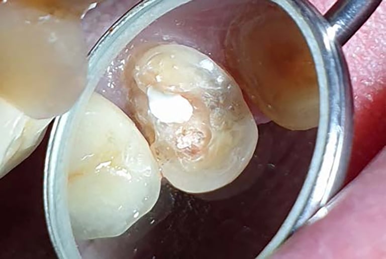 BisiCAL – Bioaktives Pulpaüberkappungsmaterial mit MTA-Füllstoffen von Bisico Bielefelder Dentalsilicone GmbH & Co. KG – Bild 3