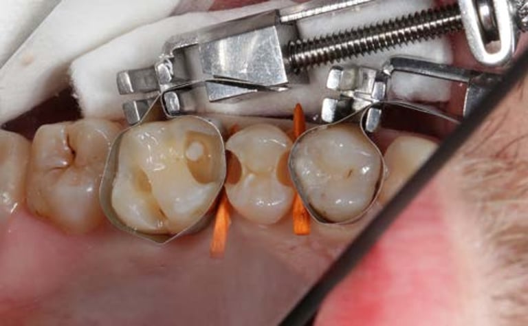 BisiCAL – Bioaktives Pulpaüberkappungsmaterial mit MTA-Füllstoffen von Bisico Bielefelder Dentalsilicone GmbH & Co. KG – Bild 4
