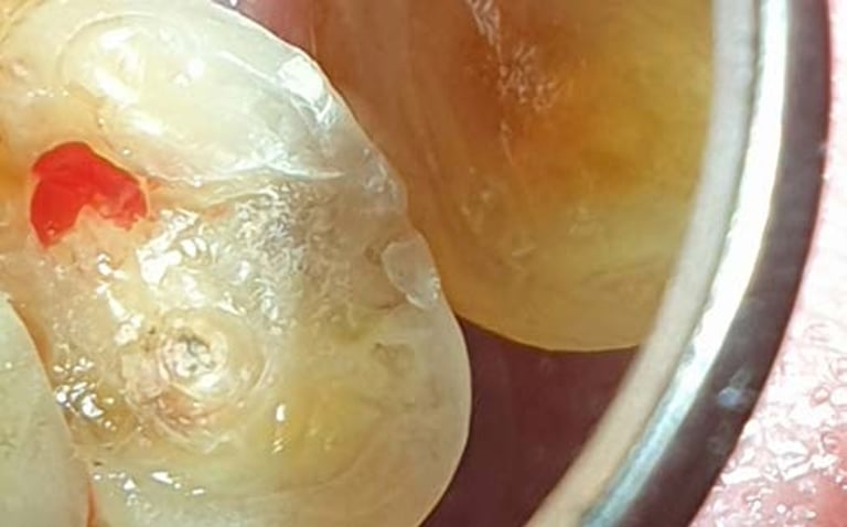 BisiCAL – Bioaktives Pulpaüberkappungsmaterial mit MTA-Füllstoffen von Bisico Bielefelder Dentalsilicone GmbH & Co. KG – Bild 5