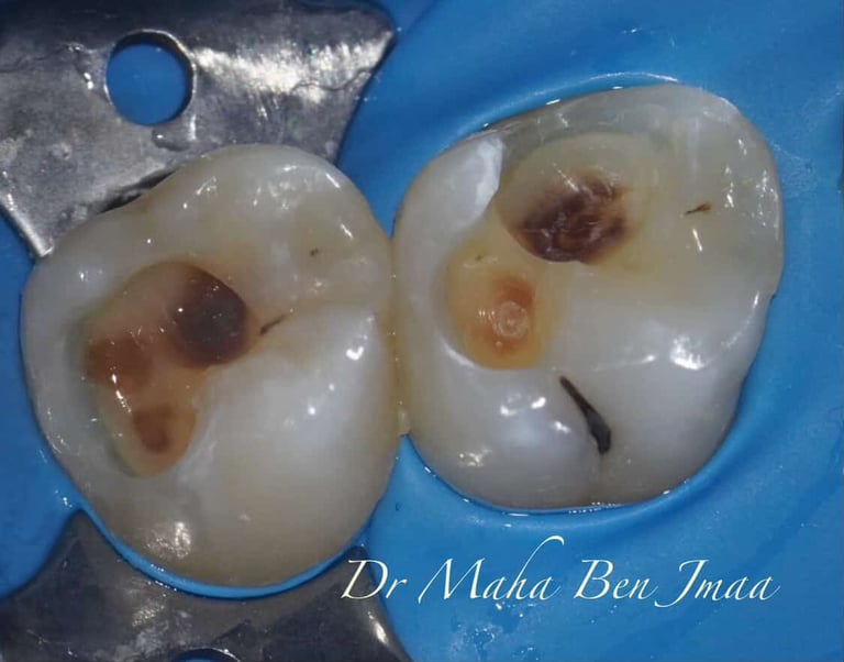 My Bio – Bis-GMA-, TEGDMA-, HEMA- und EGDMA-freies Biokomposit von Bisico Bielefelder Dentalsilicone GmbH & Co. KG – Bild 2