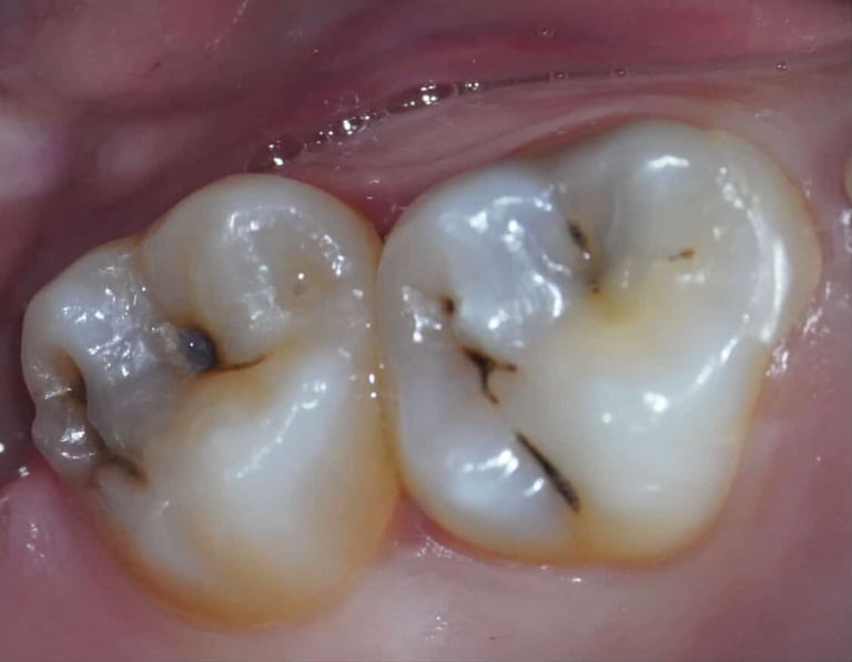 My Bio – Bis-GMA-, TEGDMA-, HEMA- und EGDMA-freies Biokomposit von Bisico Bielefelder Dentalsilicone GmbH & Co. KG – Bild 4