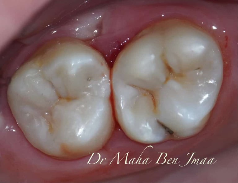 My Bio – Bis-GMA-, TEGDMA-, HEMA- und EGDMA-freies Biokomposit von Bisico Bielefelder Dentalsilicone GmbH & Co. KG – Bild 5