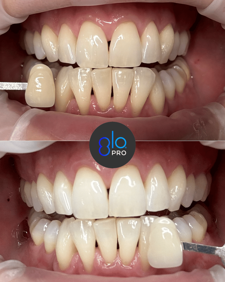 GLO PRO POWER – Kabelloses Homebleaching für Zahnarztpatienten von Bisico Bielefelder Dentalsilicone GmbH & Co. KG – Bild 5