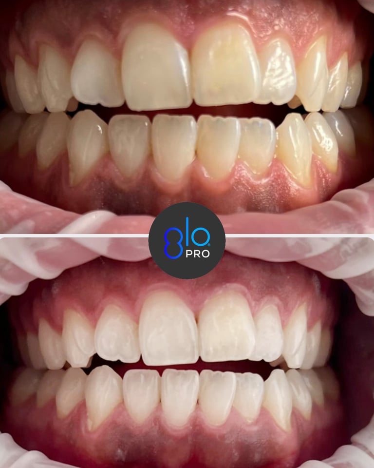 GLO PRO POWER – Kabelloses Homebleaching für Zahnarztpatienten von Bisico Bielefelder Dentalsilicone GmbH & Co. KG – Bild 6